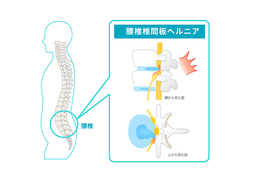 椎間板ヘルニア